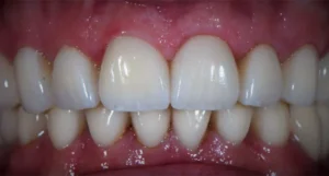 Stephanie - Dental Implants & Veneers After