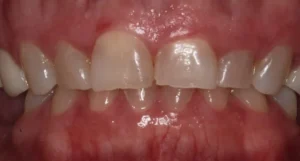 Stephanie - Dental Implants & Veneers Before