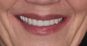 Jennifer - Full & Partial Dentures; All on 4 Dental Implants After
