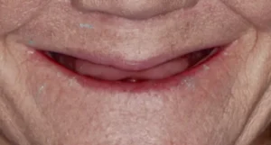 Jennifer - Full & Partial Dentures; All on 4 Dental Implants Before