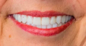 Patty - Hybrid Dental Implants After