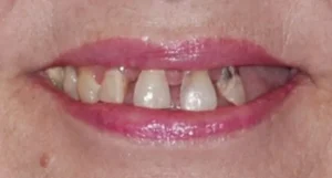 Patty - Hybrid Dental Implants Before