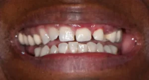Sandra - All on 4 Dental Implants Before