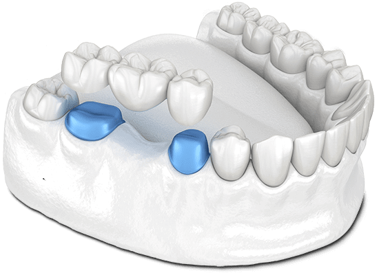 dental bridge model