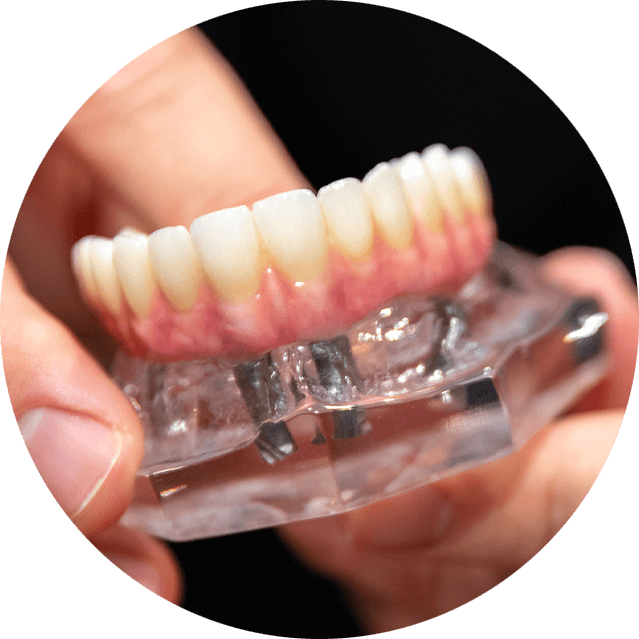 all on 4 dental implant model