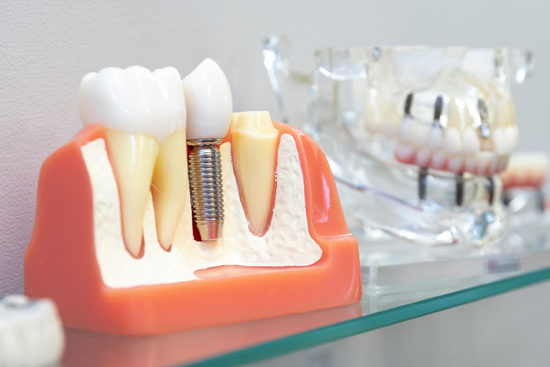 dental implant model