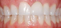 dental implants after