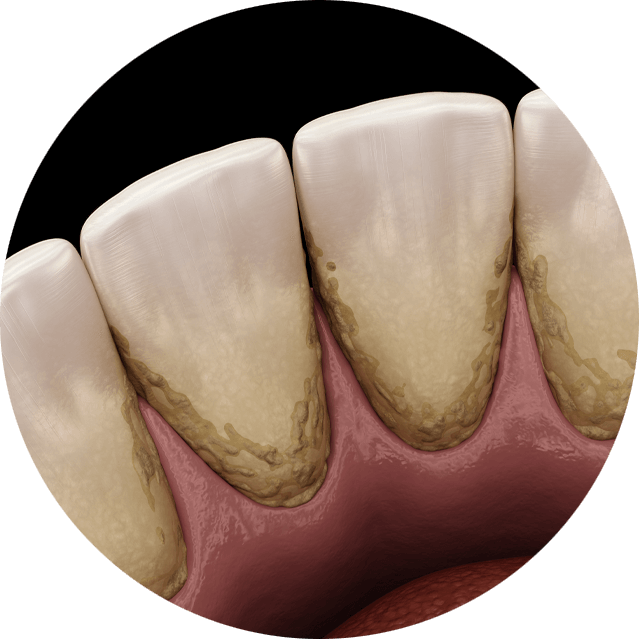 dental plaque graphic