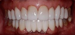 dental veneers before and after