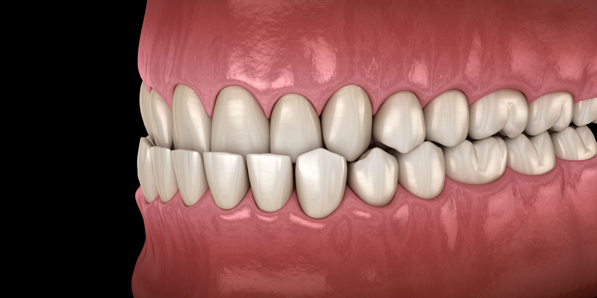 malocclusion model