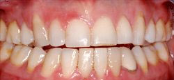orthodontics before and after