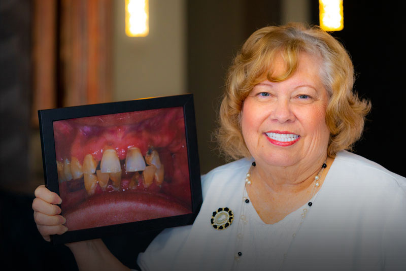 Patty - Hybrid Dental Implants