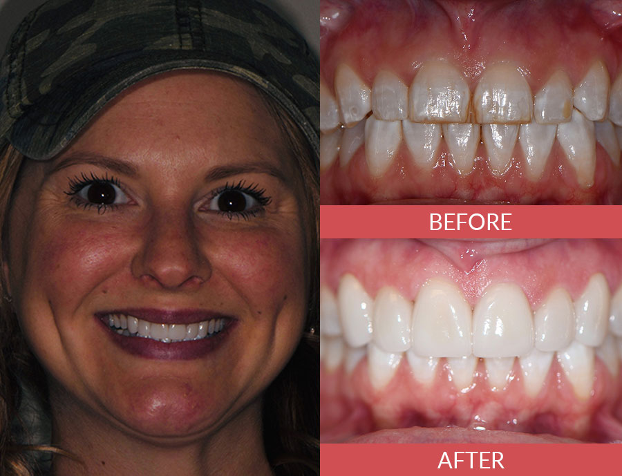 porcelain veneers before and after