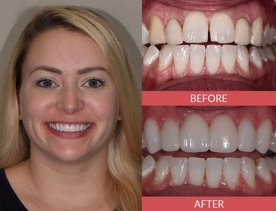 porcelain veneers before and after