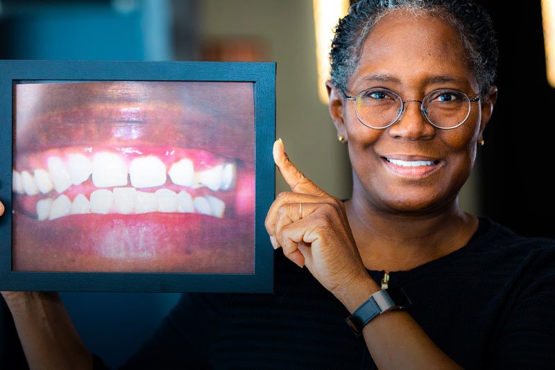 Sandra - All on 4 Dental Implants