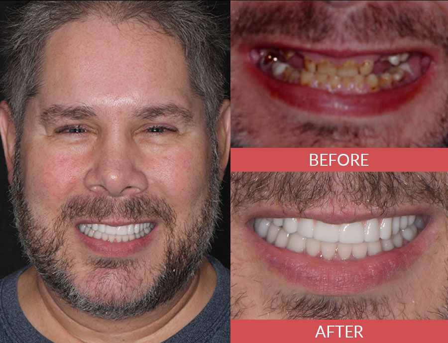 smile makeover before and after