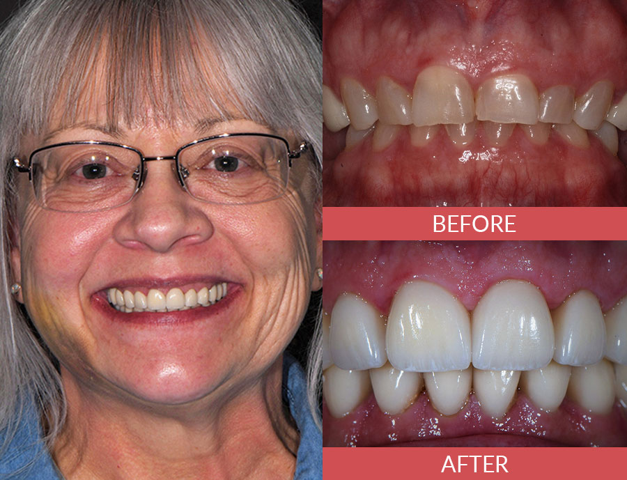 smile makeover before and after