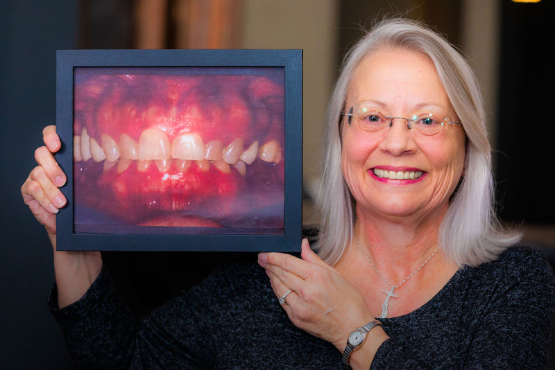 Stephanie - Dental Implants & Veneers
