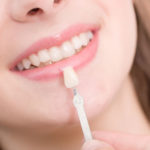 Dental Veneers, a Patient’s Story