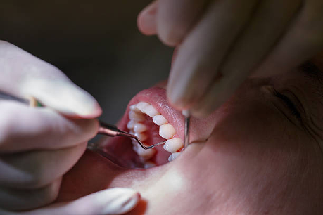 What You Need to Know About Periodontal Scaling and Root Planing