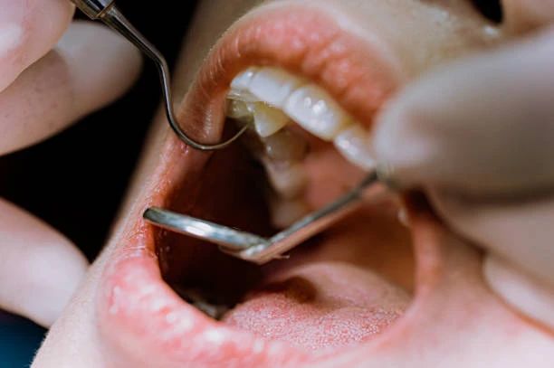 image of a patients mouth during a dental examination (1)