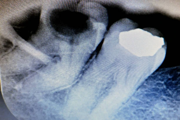 x ray of an exposed tooth roots