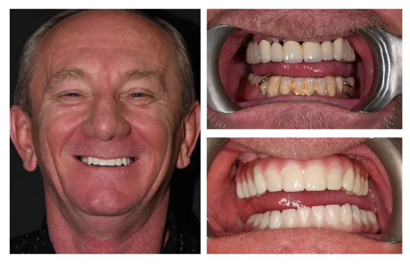 aleks fixed implants image