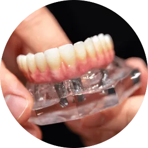 all on 4 dental implant model