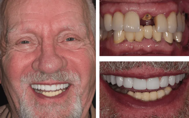 allon4 fixedbridge tabor