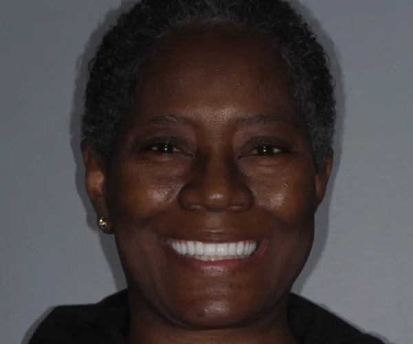 allon4 upperfixedimplantbridge after tabor