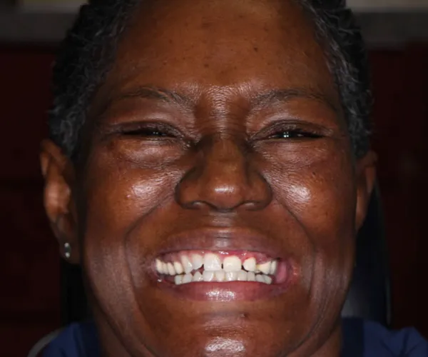 allon4 upperfixedimplantbridge before tabor