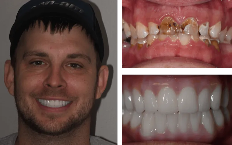 allon4 upperlowerfixedbridge tabor2