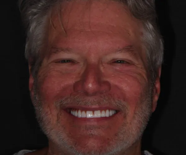 bob g fixed implants pick whatever combo you like best 7 1536x1024