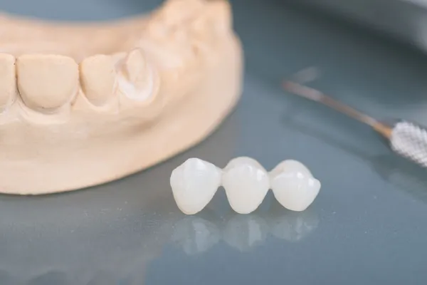 dental bridge model 2 1