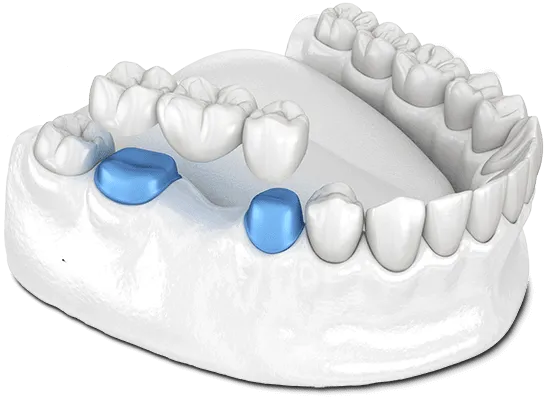 dental bridge model 2