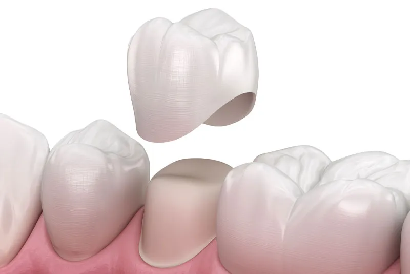 dental crown model 1
