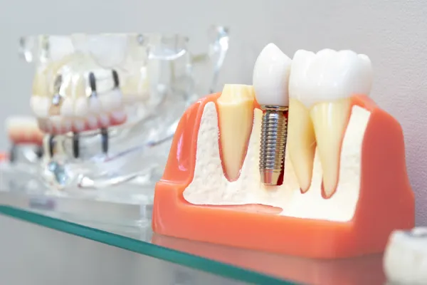 dental implant model 2