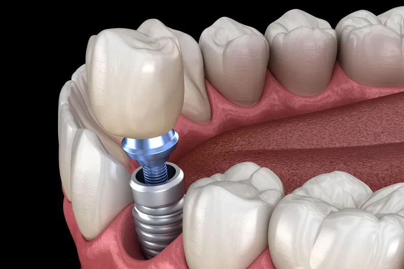 dental implant model 3