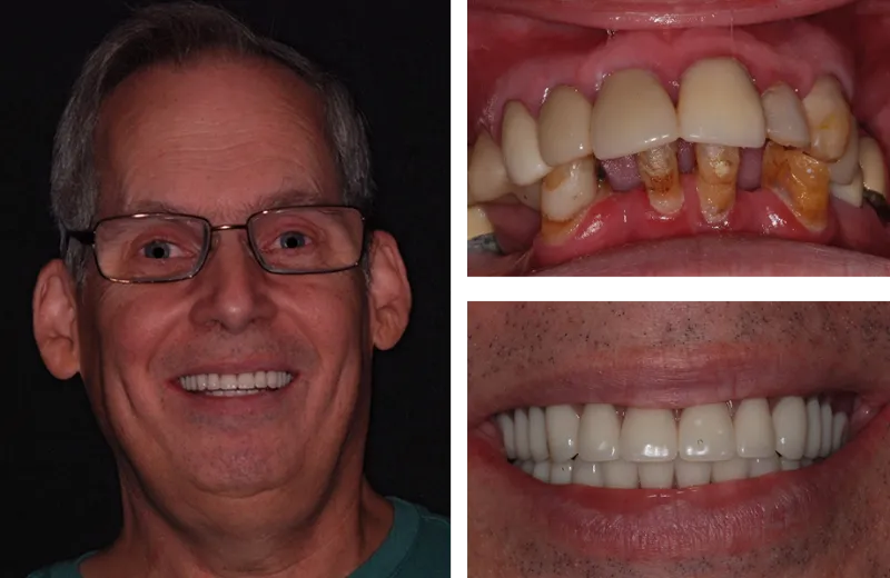 dental implants 6