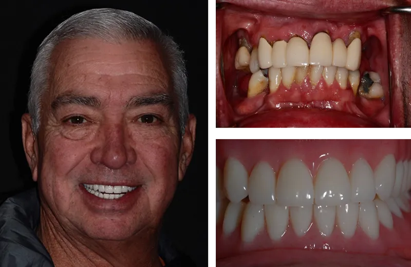 dental implants 7