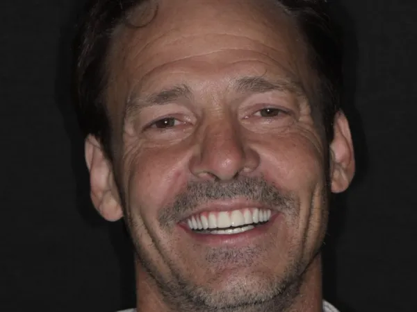 dental implants after 2