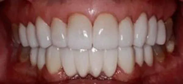 dental implants after 5