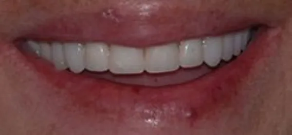 dental implants after 6