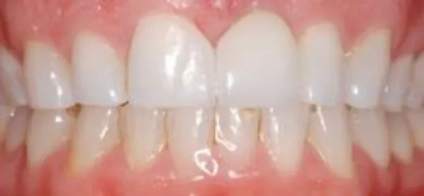 dental implants after 7