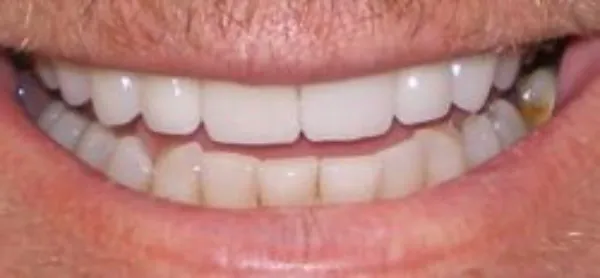 dental implants after 8
