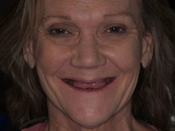 dental implants before 1