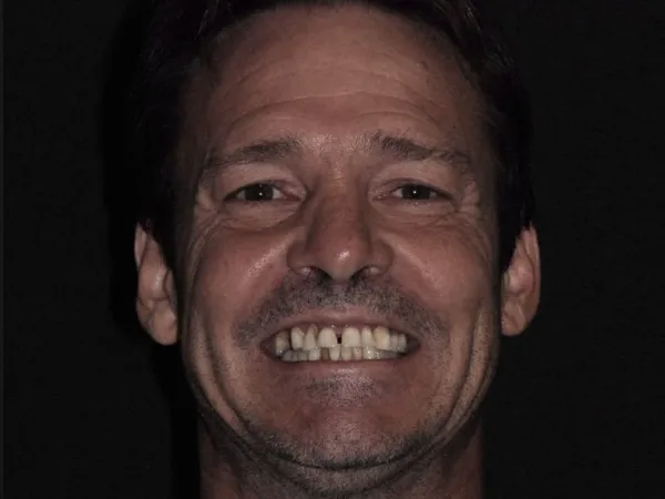 dental implants before 2