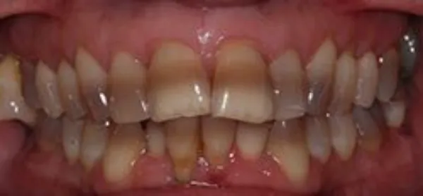 dental implants before 5