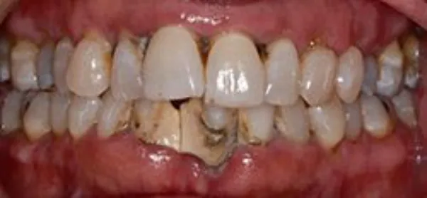 dental implants before 6