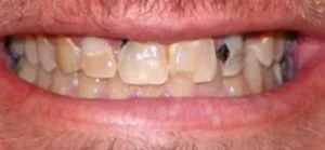 dental implants before 8